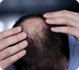 calvitie et chute de cheveux